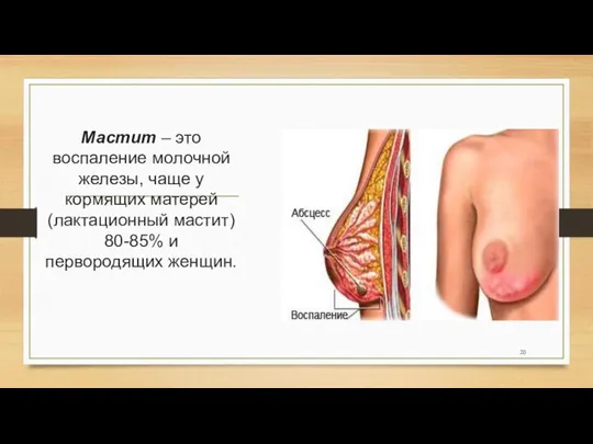 Мастит – это воспаление молочной железы, чаще у кормящих матерей (лактационный мастит) 80-85% и первородящих женщин.