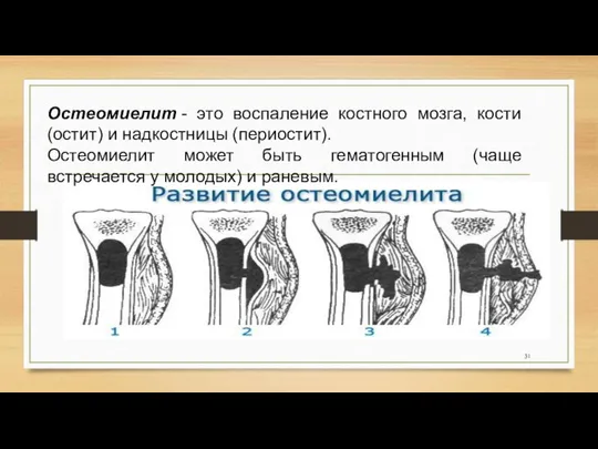 Остеомиелит - это воспаление костного мозга, кости (остит) и надкостницы (периостит).