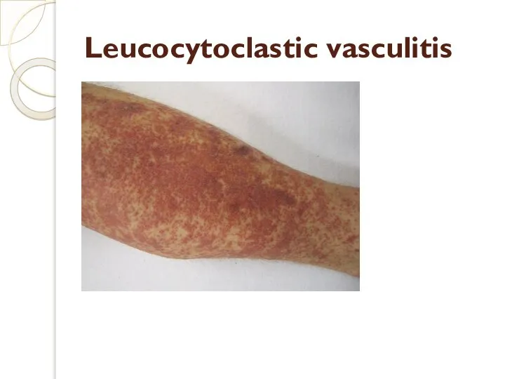 Leucocytoclastic vasculitis