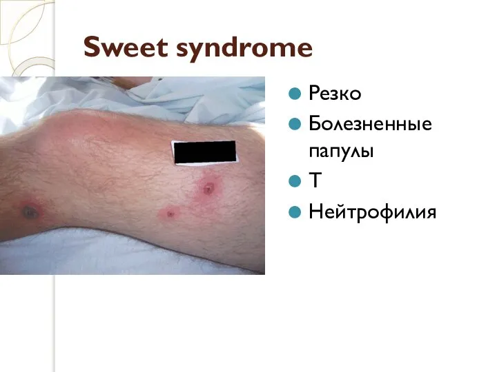 Sweet syndrome Резко Болезненные папулы Т Нейтрофилия