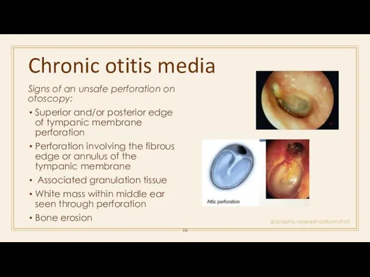 Chronic otitis media ДОБАВИТЬ НИЖНИЙ КОЛОНТИТУЛ Signs of an unsafe perforation