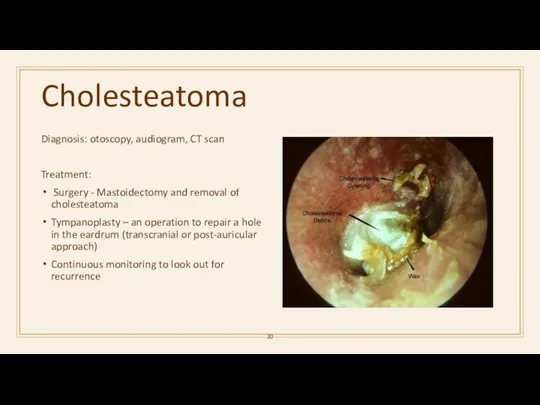 Cholesteatoma Diagnosis: otoscopy, audiogram, CT scan Treatment: Surgery - Mastoidectomy and