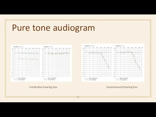 Pure tone audiogram Sensorineural hearing loss Conductive hearing loss