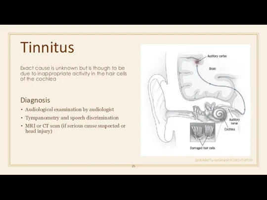 Tinnitus ДОБАВИТЬ НИЖНИЙ КОЛОНТИТУЛ Exact cause is unknown but is though