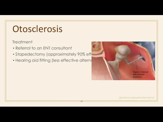 Otosclerosis ДОБАВИТЬ НИЖНИЙ КОЛОНТИТУЛ Treatment Referral to an ENT consultant Stapedectomy