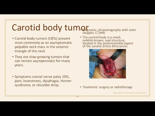 Carotid body tumor ДОБАВИТЬ НИЖНИЙ КОЛОНТИТУЛ Carotid body tumors (CBTs) present