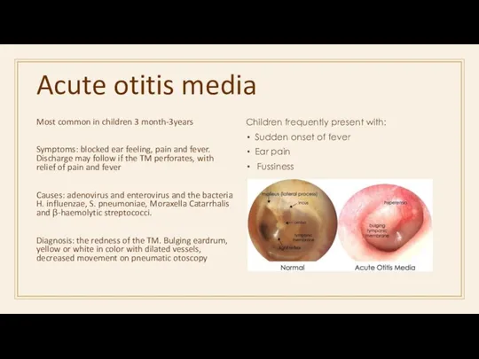 Acute otitis media Most common in children 3 month-3years Symptoms: blocked