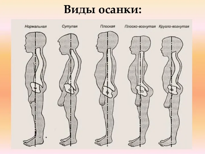 Виды осанки: