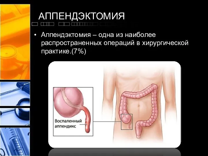 АППЕНДЭКТОМИЯ Аппендэктомия – одна из наиболее распространенных операций в хирургической практике.(7%)