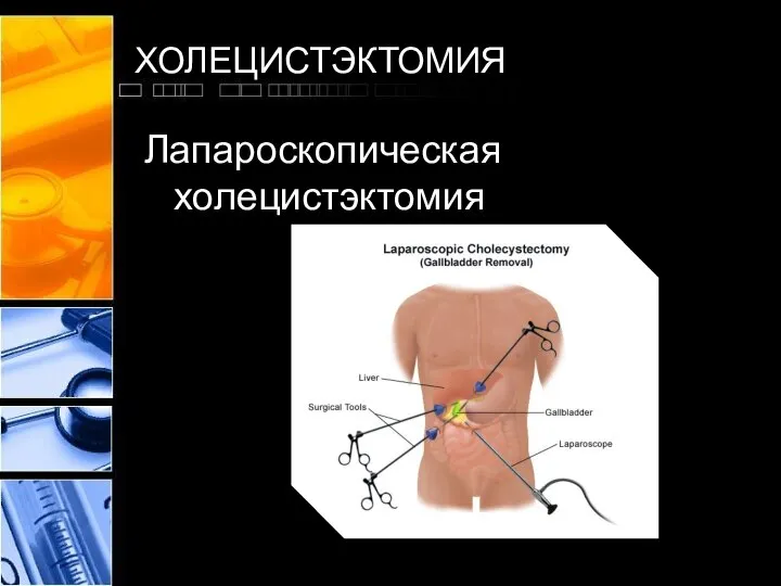 ХОЛЕЦИСТЭКТОМИЯ Лапароскопическая холецистэктомия