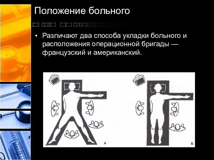 Положение больного Различают два способа укладки больного и расположения операционной бригады — французский и американский.