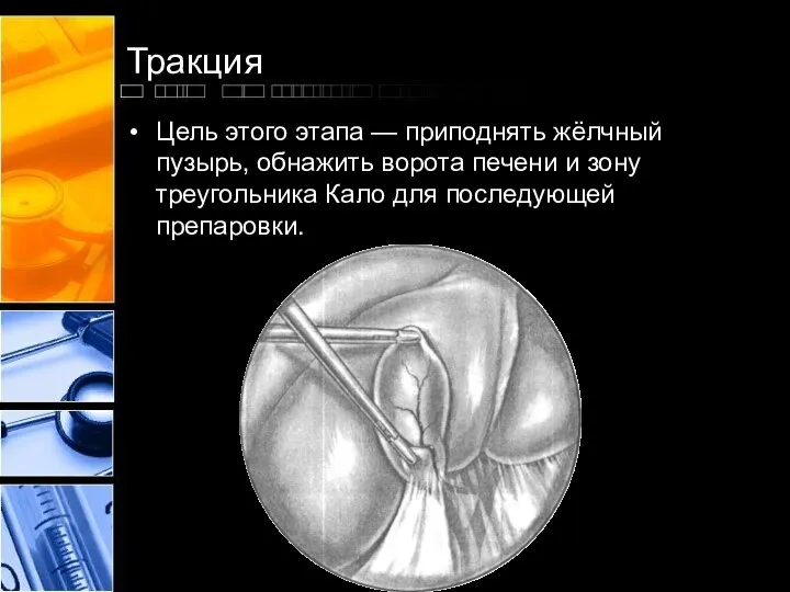 Тракция Цель этого этапа — приподнять жёлчный пузырь, обнажить ворота печени