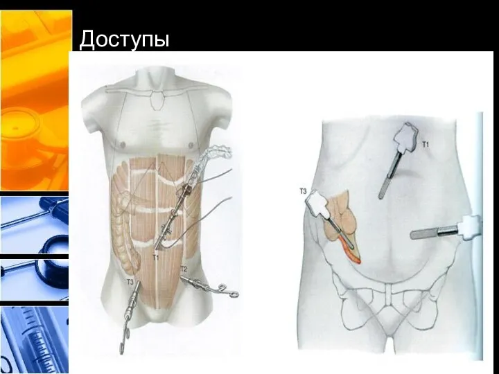 Доступы первый троакар вводят параумбиликально, Дополнительно 5-миллиметровый манипулятор 10-миллиметровый троакар вводят