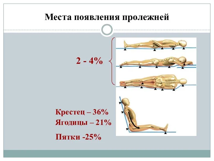 Места появления пролежней 2 - 4% Крестец – 36% Ягодицы – 21% Пятки -25%