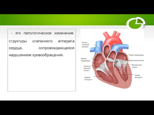 Порок сердца - это патологическое изменение структуры клапанного аппарата сердца, сопровождающееся нарушением кровообращения.