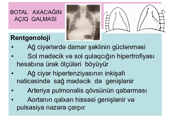 BOTAL AXACAĞIN AÇIQ QALMASI Rentgenoloji Ağ ciyərlərdə damar şəklinin güclənməsi Sol