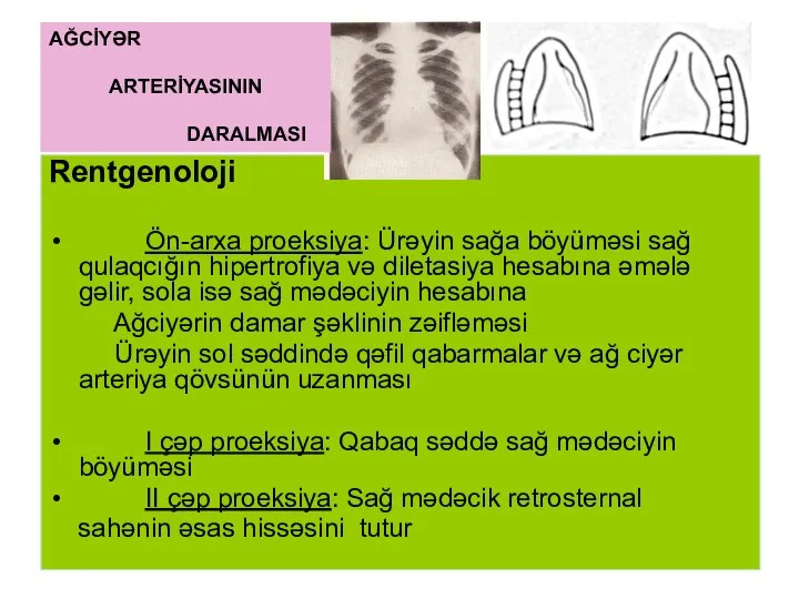 Rentgenoloji Ön-arxa proeksiya: Ürəyin sağa böyüməsi sağ qulaqcığın hipertrofiya və diletasiya