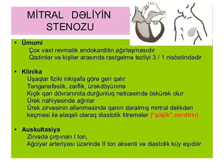 MİTRAL DƏLİYİN STENOZU Ümumi Çox vaxt revmatik endokarditin ağırlaşmasıdır Qadınlar və