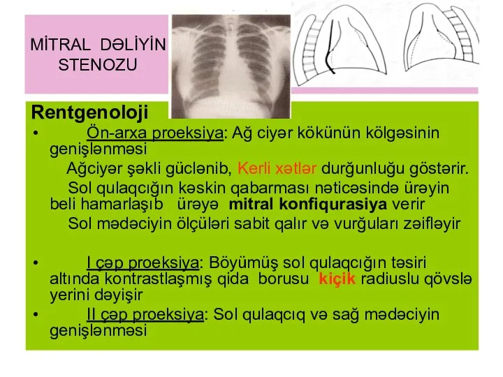 MİTRAL DƏLİYİN STENOZU Rentgenoloji Ön-arxa proeksiya: Ağ ciyər kökünün kölgəsinin genişlənməsi