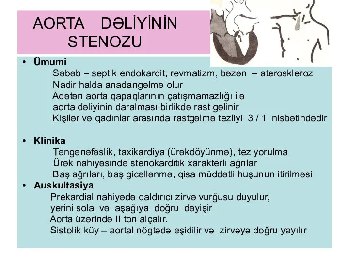 AORTA DƏLİYİNİN STENOZU Ümumi Səbəb – septik endokardit, revmatizm, bəzən –