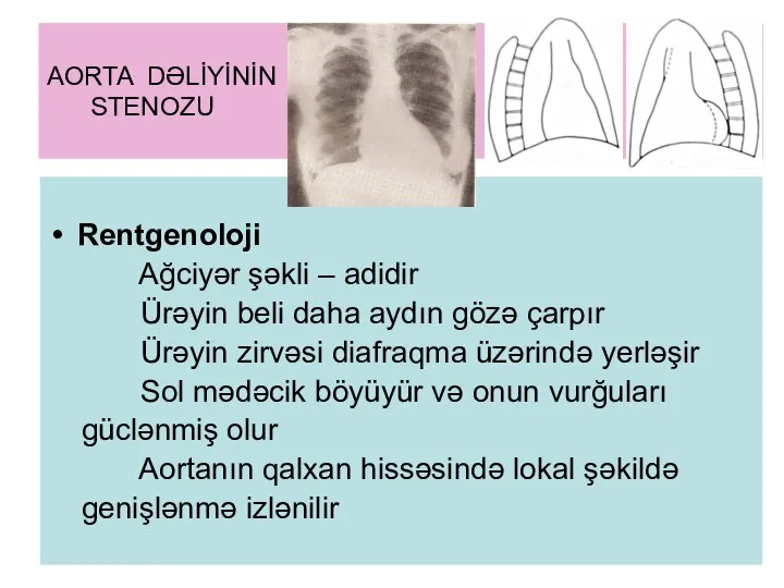 AORTA DƏLİYİNİN STENOZU Rentgenoloji Ağciyər şəkli – adidir Ürəyin beli daha