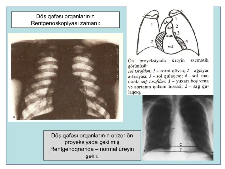 Döş qəfəsı orqanlarının obzor ön proyeksiyada çəkilmiş Rentgenoqramda – normal ürəyin