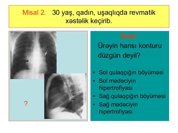 Misal 2. 30 yaş, qadın, uşaqlıqda revmatik xəstəlik keçirib. ? Sual