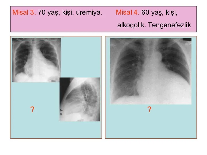 Misal 3. 70 yaş, kişi, uremiya. Misal 4. 60 yaş, kişi, alkoqolik. Təngənəfəzlik ? ?