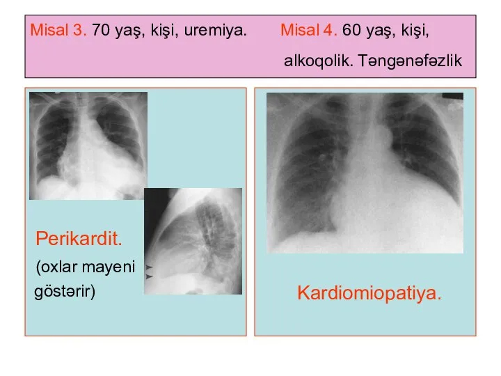 Misal 3. 70 yaş, kişi, uremiya. Misal 4. 60 yaş, kişi,