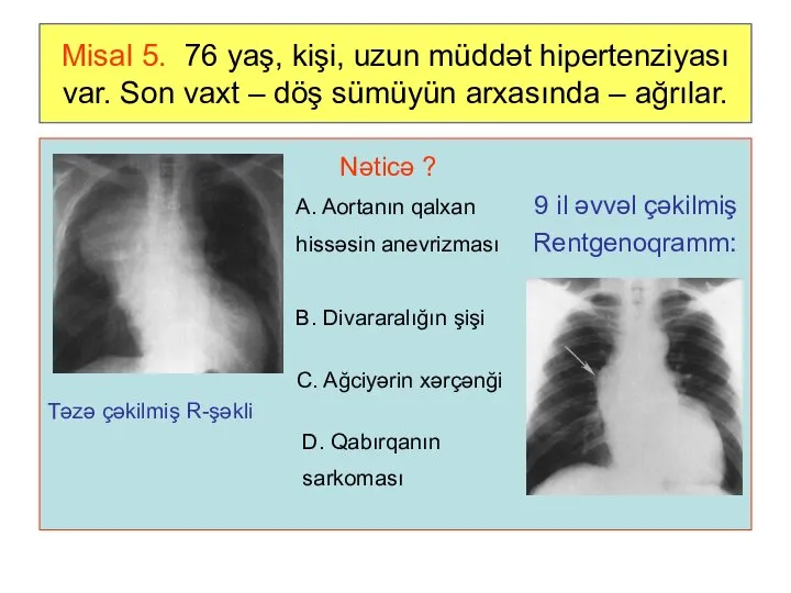 Misal 5. 76 yaş, kişi, uzun müddət hipertenziyası var. Son vaxt