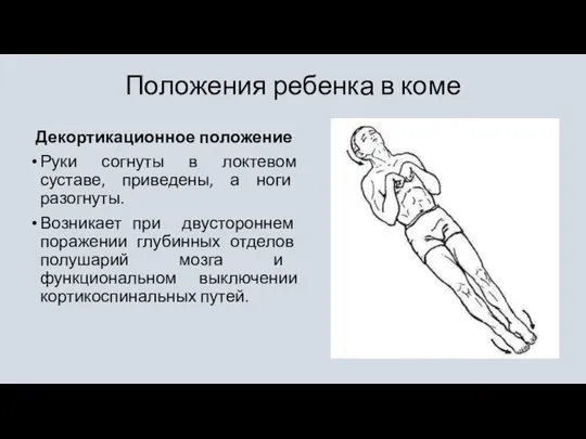 Положения ребенка в коме Декортикационное положение Руки согнуты в локтевом суставе,