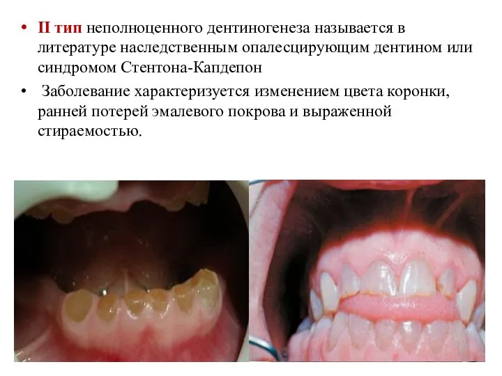 II тип неполноценного дентиногенеза называется в литературе наследственным опалесцирующим дентином или