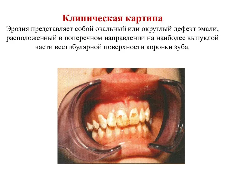 Клиническая картина Эрозия представляет собой овальный или округлый дефект эмали, расположенный