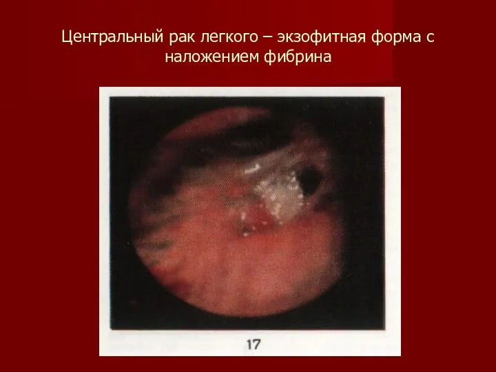 Центральный рак легкого – экзофитная форма с наложением фибрина