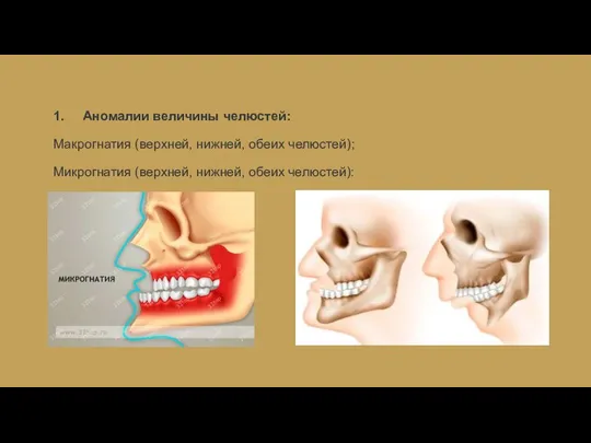 1. Аномалии величины челюстей: Макрогнатия (верхней, нижней, обеих челюстей); Микрогнатия (верхней, нижней, обеих челюстей):