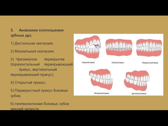 3. Аномалии соотношения зубных дуг, 1) Дистальная окклюзия; 2) Мезиальная окклюзия;