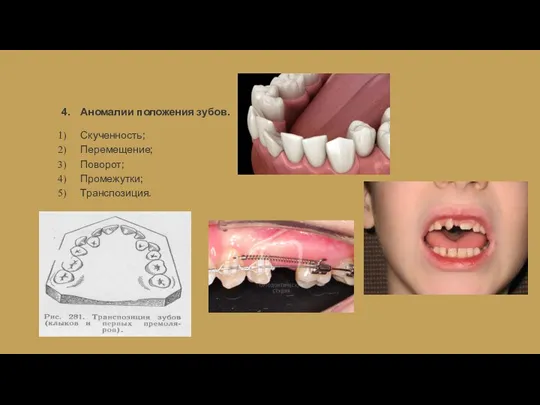 4. Аномалии положения зубов. Скученность; Перемещение; Поворот; Промежутки; Транспозиция.