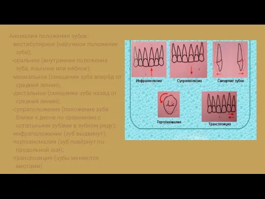 Аномалии положения зубов: -вeстибулярное (наружное положение зуба); -оральное (внутреннее положение зуба,