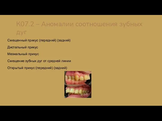 К07.2 – Аномалии соотношения зубных дуг Смещенный прикус (передний) (задний) Дистальный