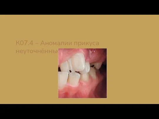 К07.4 – Аномалии прикуса неуточнённые;