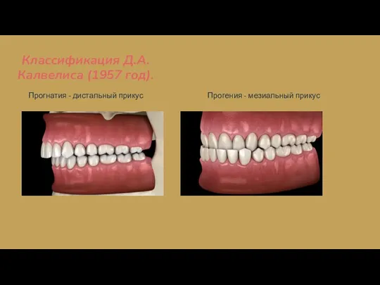 Классификация Д.А. Калвелиса (1957 год). Прогнатия - дистальный прикус Прогения - мезиальный прикус