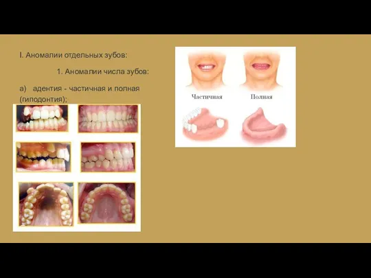 I. Аномалии отдельных зубов: 1. Аномалии числа зубов: а) адентия - частичная и полная (гиподонтия);