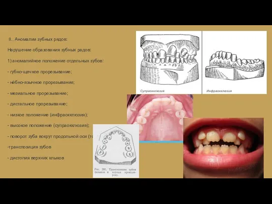 II.. Аномалии зубных рядов: Нарушение образования зубных радов: 1) аномалийное положение