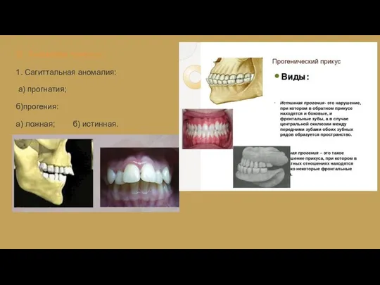 III. Аномалии прикуса: 1. Сагиттальная аномалия: а) прогнатия; б)прогения: а) ложная; б) истинная.