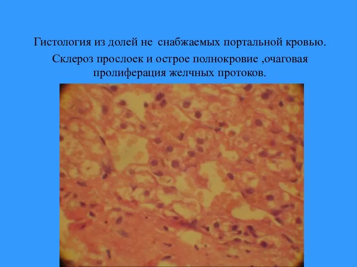 Гистология из долей не снабжаемых портальной кровью. Склероз прослоек и острое полнокровие ,очаговая пролиферация желчных протоков.