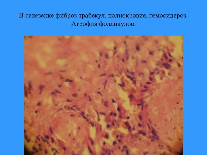 В селезенке фиброз трабекул, полнокровие, гемосидероз. Атрофия фолликулов.
