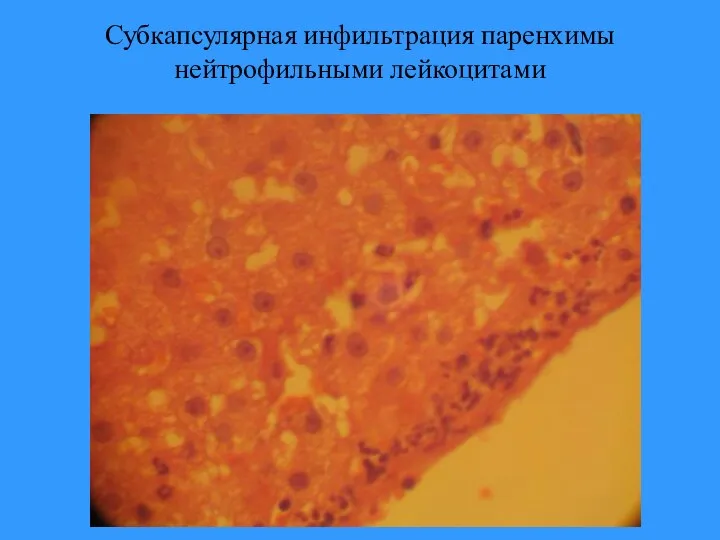 Субкапсулярная инфильтрация паренхимы нейтрофильными лейкоцитами