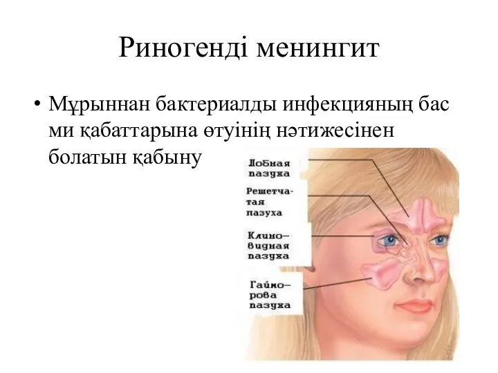 Риногенді менингит Мұрыннан бактериалды инфекцияның бас ми қабаттарына өтуінің нәтижесінен болатын қабыну