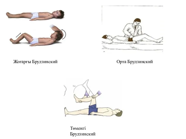 Жоғарғы Брудзинский Орта Брудзинский Төменгі Брудзинский