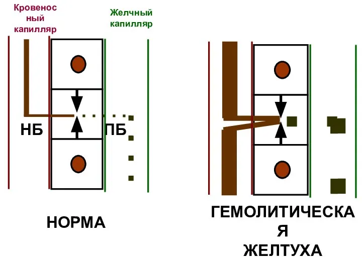 НБ ПБ Кровеносный капилляр Желчный капилляр НОРМА ГЕМОЛИТИЧЕСКАЯ ЖЕЛТУХА